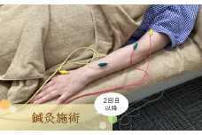 【2回目以降】鍼灸　【12203-0167】